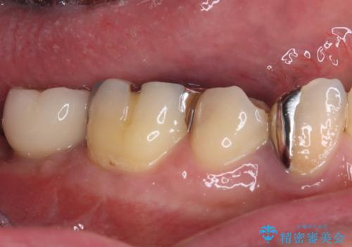 欠損と治療途中の奥歯 インプラント治療と補綴治療の治療後