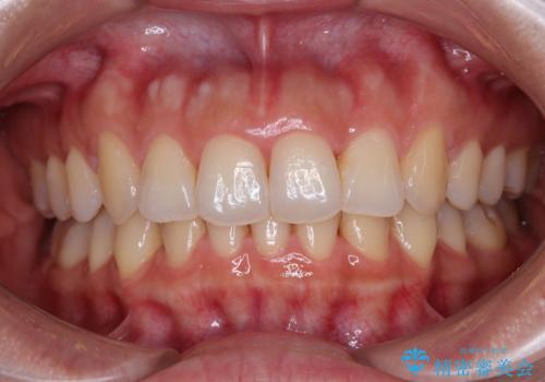捻れた前歯をインビザラインで整えるの症例 治療後