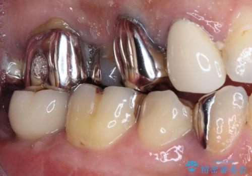 欠損と治療途中の奥歯 インプラント治療と補綴治療の治療後