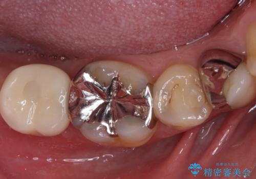 欠損と治療途中の奥歯　インプラント治療と補綴治療