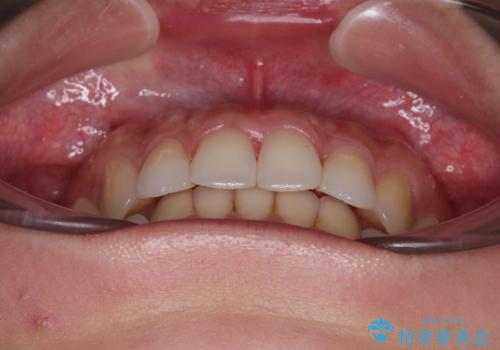 捻れた前歯をインビザラインで整えるの治療後