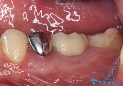 欠損と治療途中の奥歯 インプラント治療と補綴治療の治療後