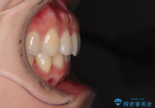 捻れた前歯をインビザラインで整えるの治療後