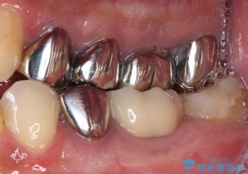 欠損と治療途中の奥歯 インプラント治療と補綴治療の治療後
