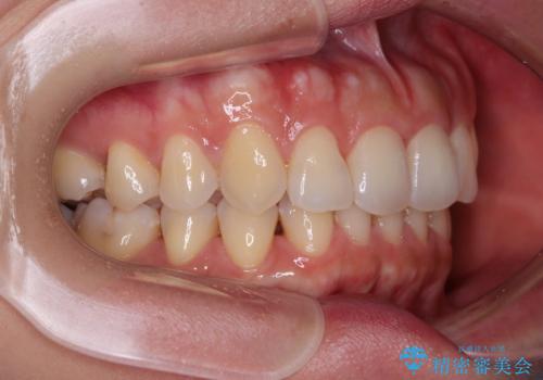 捻れた前歯をインビザラインで整えるの治療後