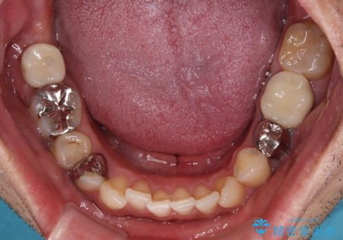 欠損と治療途中の奥歯 インプラント治療と補綴治療の症例 治療後