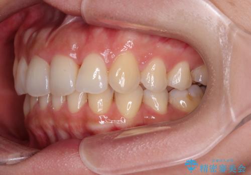 捻れた前歯をインビザラインで整えるの治療後