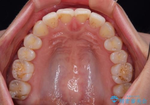 捻れた前歯をインビザラインで整えるの治療後