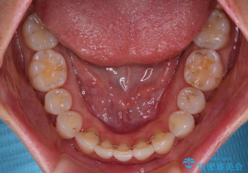 捻れた前歯をインビザラインで整えるの治療後