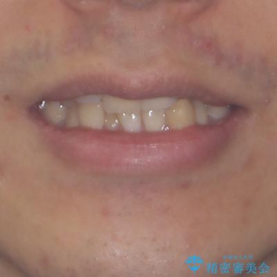 抜歯矯正で八重歯を改善 インビザライン矯正治療の治療前(顔貌)