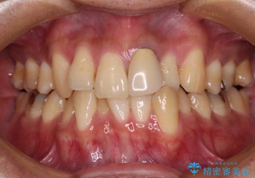 抜歯矯正で八重歯を改善　インビザライン矯正治療の症例 治療前