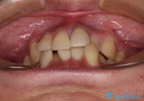 抜歯矯正で八重歯を改善 インビザライン矯正治療の治療前