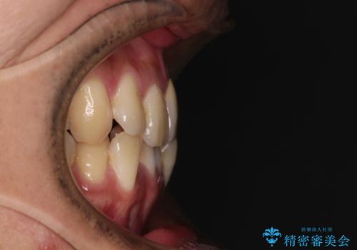 抜歯矯正で八重歯を改善 インビザライン矯正治療の治療前