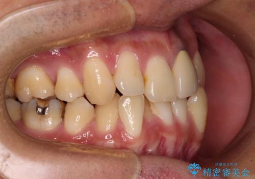 抜歯矯正で八重歯を改善 インビザライン矯正治療の治療前