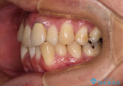 抜歯矯正で八重歯を改善　インビザライン矯正治療の治療前