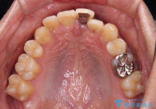 抜歯矯正で八重歯を改善 インビザライン矯正治療の治療前