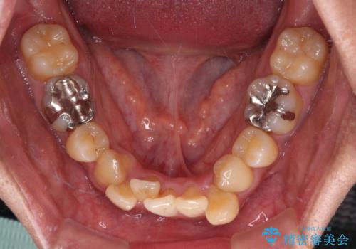 抜歯矯正で八重歯を改善 インビザライン矯正治療の治療前