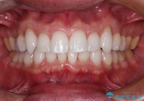 中等度歯列不正　インビザライン・モデレートによる矯正治療の症例 治療後