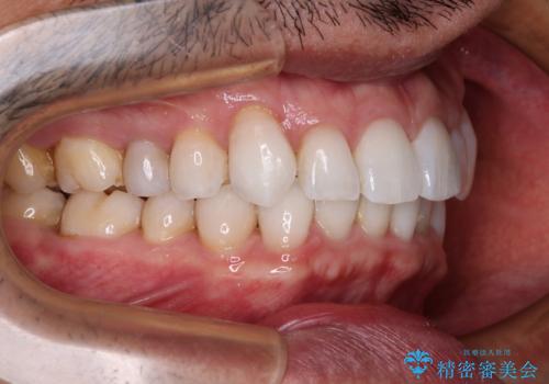 中等度歯列不正　インビザライン・モデレートによる矯正治療の治療後