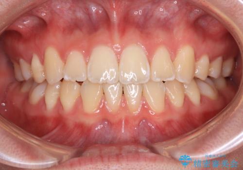 前歯が2本ない　ワイヤー装置での抜歯矯正の症例 治療後