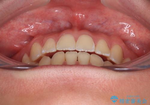 前歯が2本ない ワイヤー装置での抜歯矯正の治療後