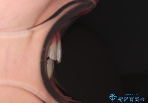 前歯が2本ない ワイヤー装置での抜歯矯正の治療後