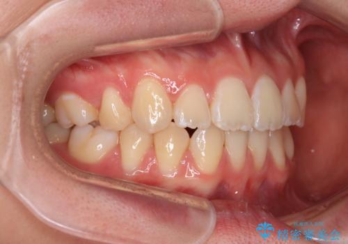 前歯が2本ない　ワイヤー装置での抜歯矯正の治療後