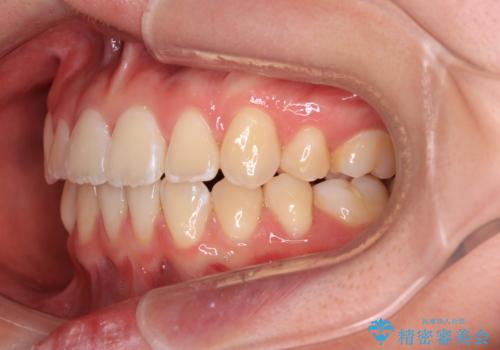 前歯が2本ない　ワイヤー装置での抜歯矯正の治療後