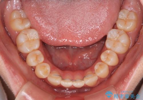 前歯が2本ない ワイヤー装置での抜歯矯正の治療後