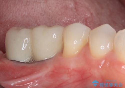不正咬合で抜歯となった奥歯　インプラントによる咬合回復の治療後