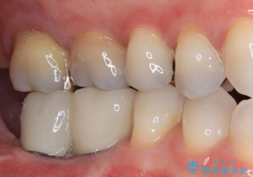 不正咬合で抜歯となった奥歯　インプラントによる咬合回復の症例 治療後