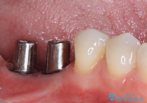 不正咬合で抜歯となった奥歯　インプラントによる咬合回復の治療中