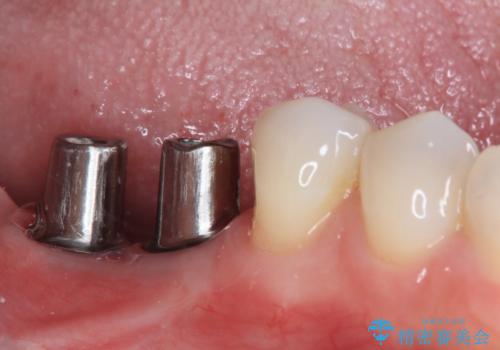 不正咬合で抜歯となった奥歯 インプラントによる咬合回復の治療中