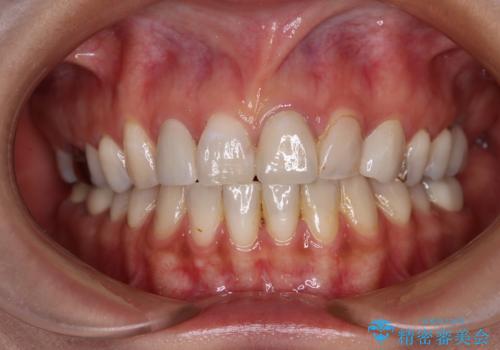 大きなむし歯と欠損をセラミックに　部分矯正を併用した総合歯科治療の症例 治療後