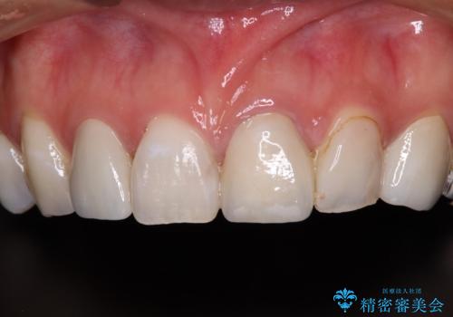 大きなむし歯と欠損をセラミックに 部分矯正を併用した総合歯科治療の治療後