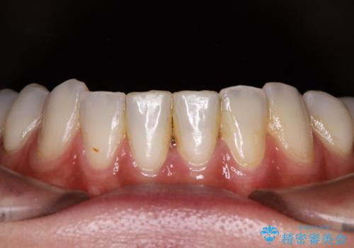 大きなむし歯と欠損をセラミックに 部分矯正を併用した総合歯科治療の治療後
