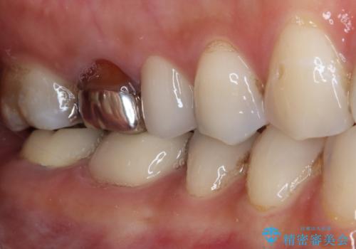 大きなむし歯と欠損をセラミックに 部分矯正を併用した総合歯科治療の治療後