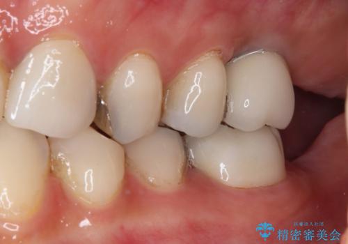 大きなむし歯と欠損をセラミックに 部分矯正を併用した総合歯科治療の治療後