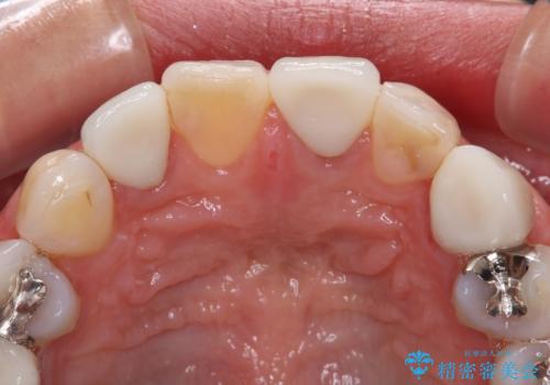 大きなむし歯と欠損をセラミックに　部分矯正を併用した総合歯科治療の治療後