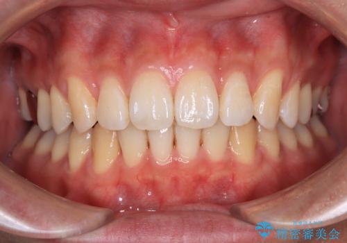 深い咬み合わせと前歯の隙間　ハーフリンガルによる矯正治療