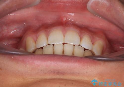 深い咬み合わせと前歯の隙間 ハーフリンガルによる矯正治療の治療後