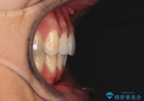 深い咬み合わせと前歯の隙間 ハーフリンガルによる矯正治療の治療後