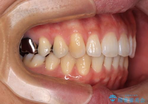 深い咬み合わせと前歯の隙間 ハーフリンガルによる矯正治療の治療後