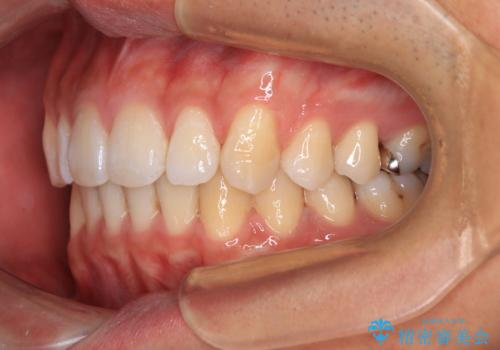 深い咬み合わせと前歯の隙間　ハーフリンガルによる矯正治療の治療後