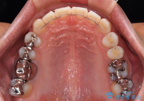 深い咬み合わせと前歯の隙間　ハーフリンガルによる矯正治療の治療後