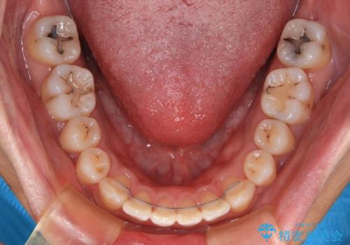 深い咬み合わせと前歯の隙間 ハーフリンガルによる矯正治療の治療後
