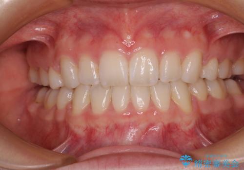 【モニター】口が閉じにくい 膨らんだ口元を抜歯矯正ですっきりと