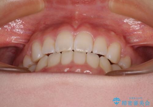 【モニター】口が閉じにくい 膨らんだ口元を抜歯矯正ですっきりとの治療後
