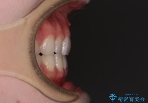 【モニター】口が閉じにくい 膨らんだ口元を抜歯矯正ですっきりとの治療後