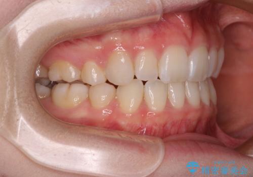 【モニター】口が閉じにくい 膨らんだ口元を抜歯矯正ですっきりとの治療後